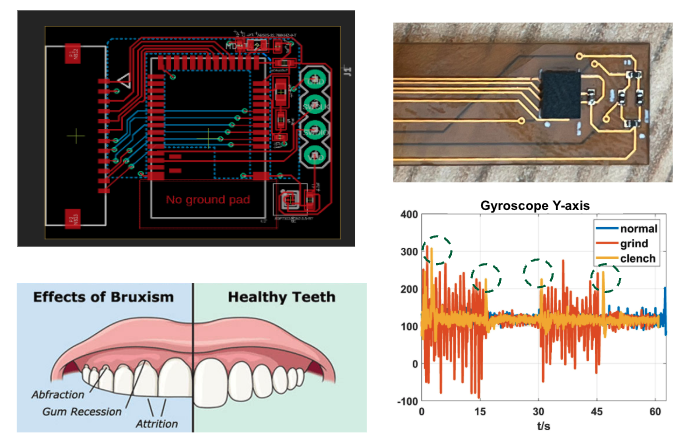 Mechanoacoustic wearable for physiological event detection